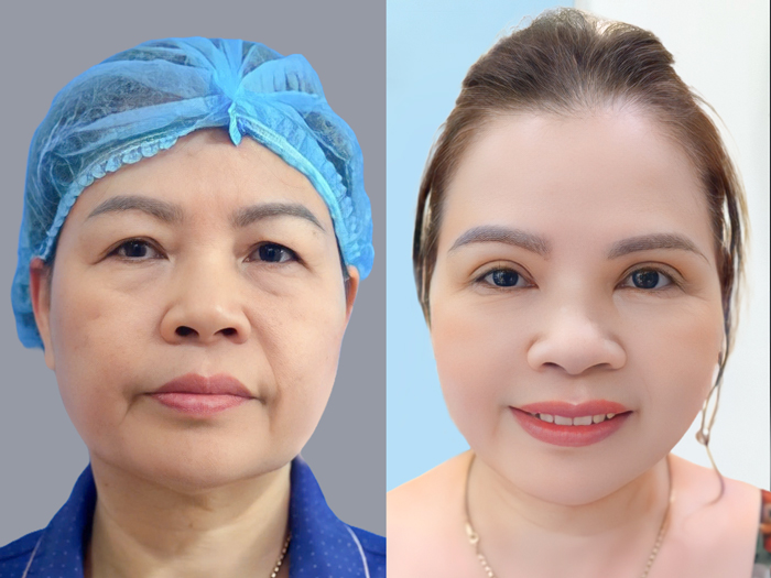 Ptosis correction may improve eyelid balance and, in suitable cases, expand the upper visual field.