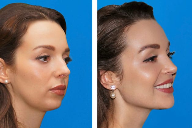 Banish an aged appearance by lifting the cheekbones. 