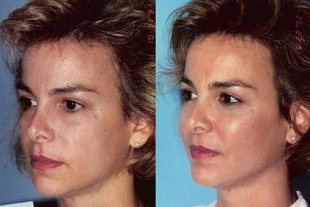 Lifting the cheekbones helps firm up the cheek area. 