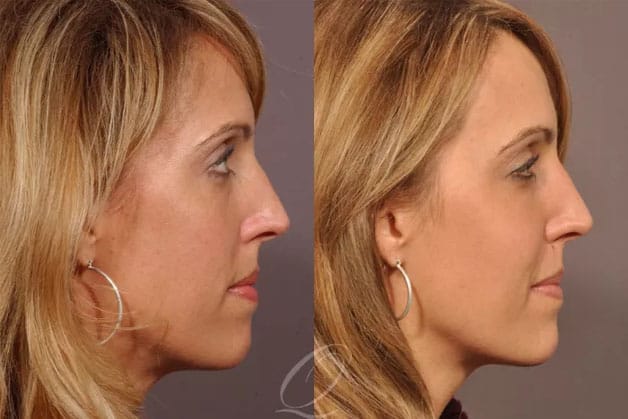 Firm, high cheekbones; reduction of wrinkles and signs of aging. 