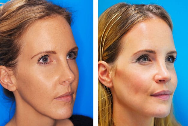 In the West, high cheekbones are generally highly prized. 