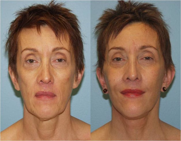 Lifting the cheekbones gives the face a youthful and vibrant appearance. 
