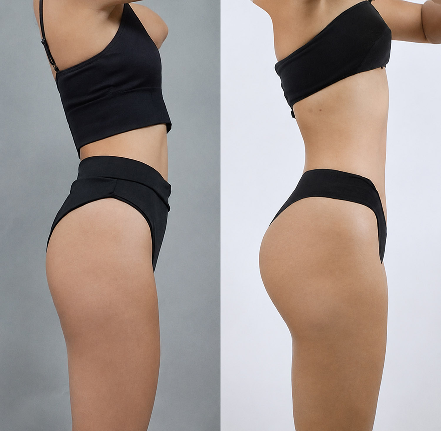 Using abdominal fat for buttock enhancement may create a slimmer waist and fuller lower-body contour.