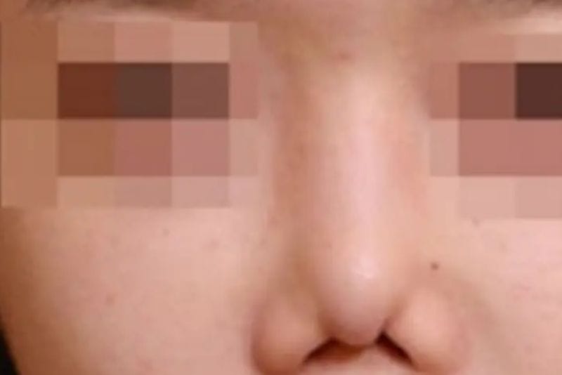 Deformed nose following improperly executed thread lifting
