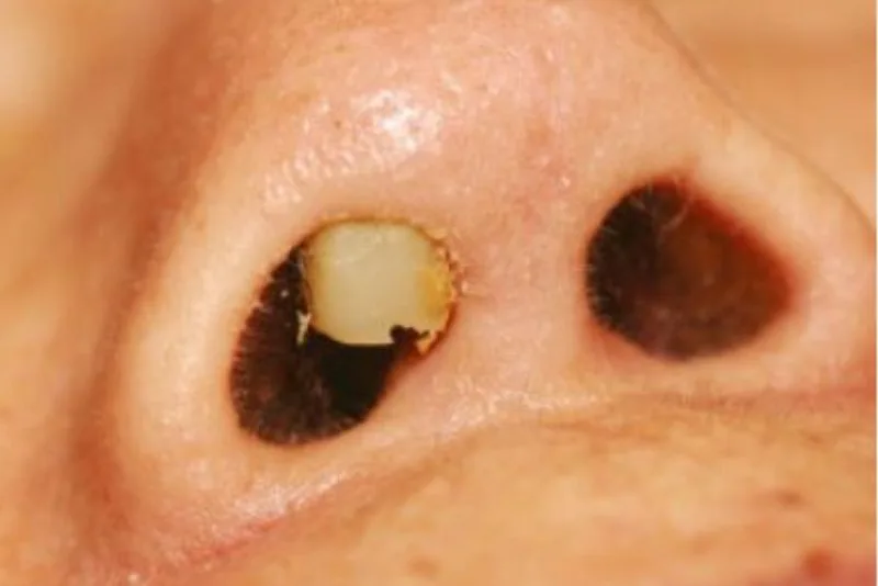 Condition of septal cartilage exposure