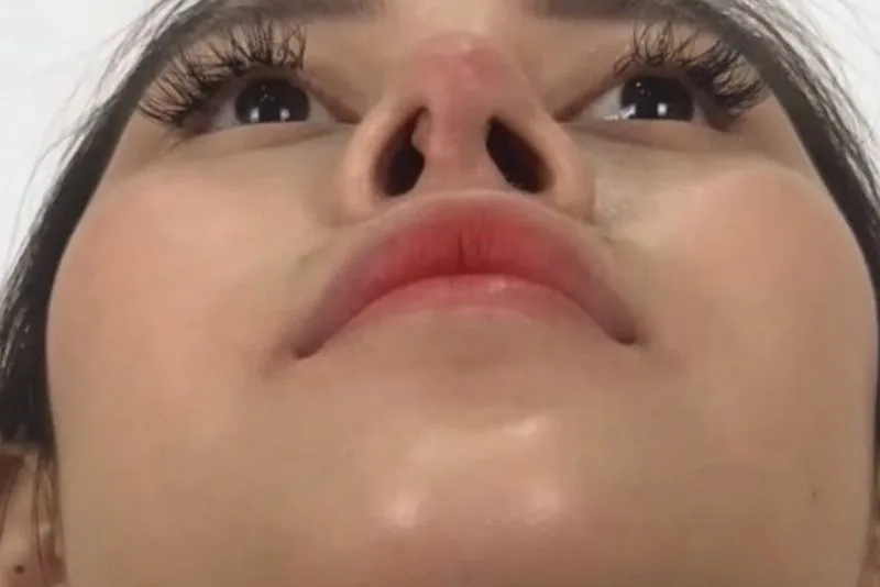  Severe impacts causing nasal cartilage exposure