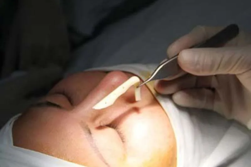 Cartilage removal and treatment of damaged tissue area