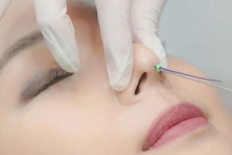 Non-surgical thread nose lifting with no downtime required