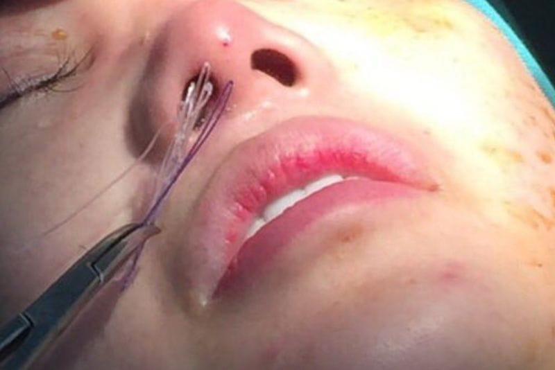 Exposed threads impacting the nasal area