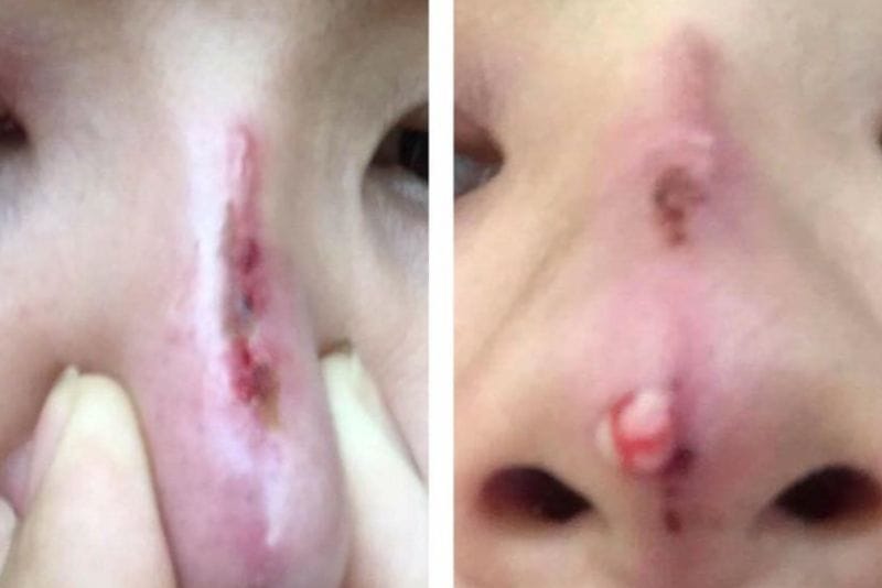 Complication of exposed nose lifting threads