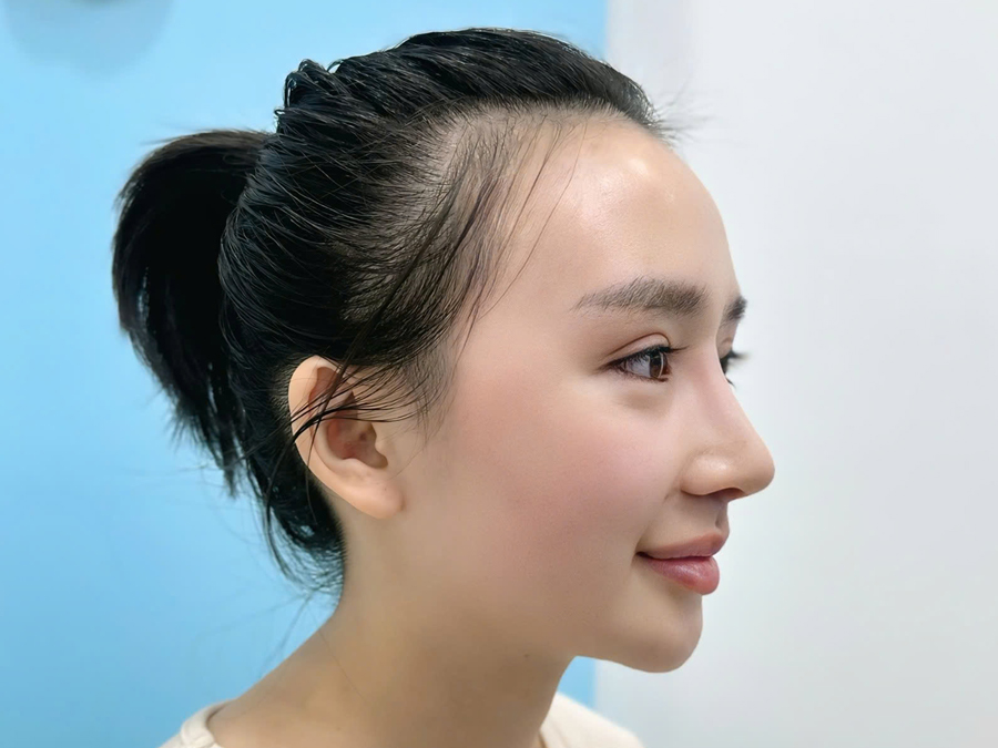 A suitable S-Line design may create a softer and more natural-looking nasal profile.