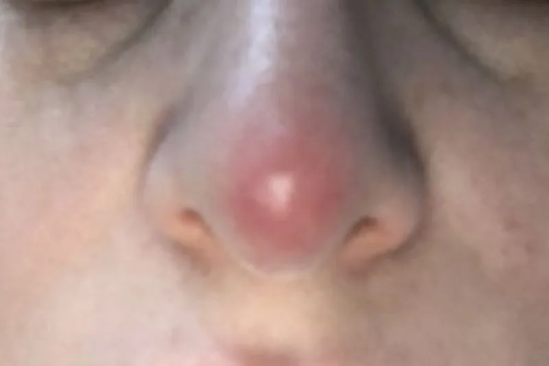 Nasal tip redness after surgery is a fairly normal occurrence