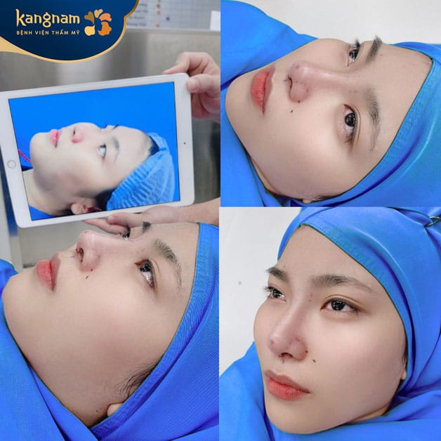 Sụn sườn nâng mũi an toàn với cơ thể