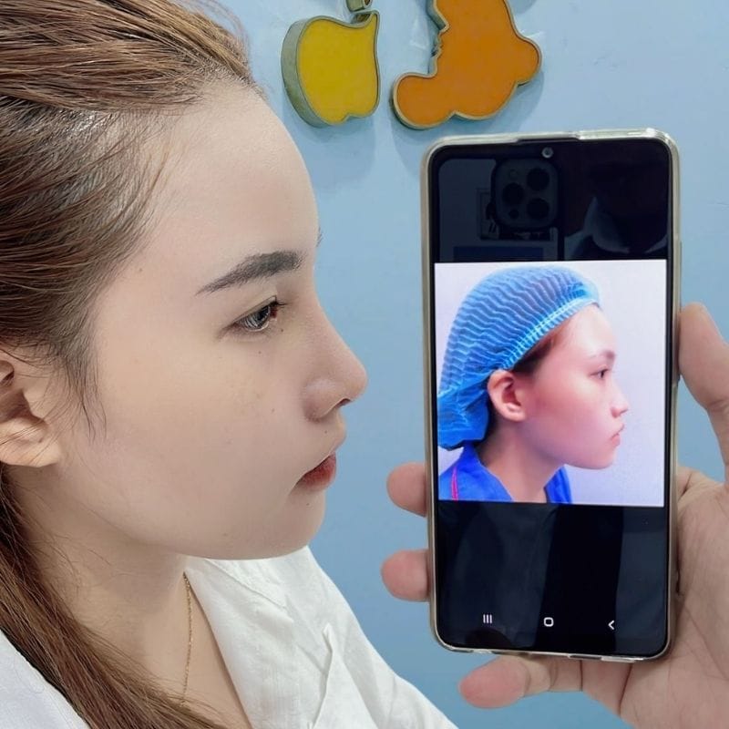 Khách hàng Việt kiều nâng mũi tại Kangnam, sống mũi cao, hài hòa với gương mặt