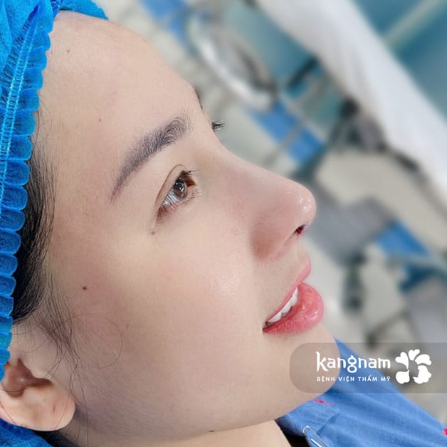 Autologous cartilage may be combined with an implant to support different parts of the nose.
