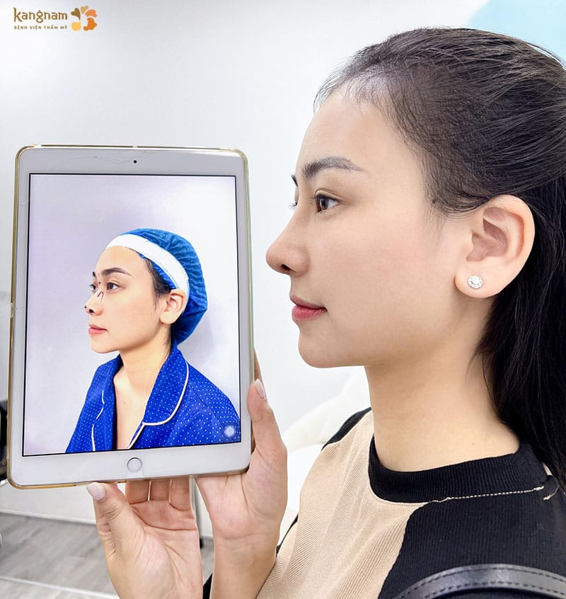 Overseas Vietnamese patients should choose surgical rhinoplasty to achieve optimal results.