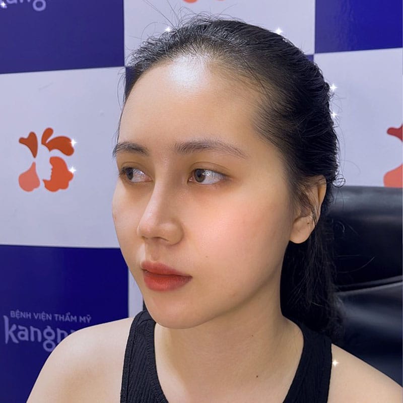 Cartilage-wrapped rhinoplasty creates a natural-looking nasal shape.