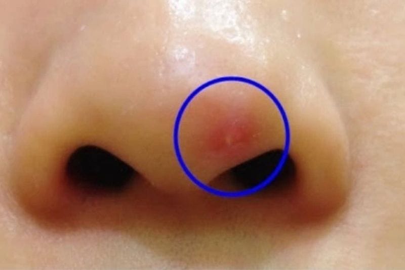 Complications may occur following rhinoplasty.