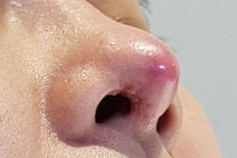 Inflammation or implant exposure may occur after rhinoplasty.