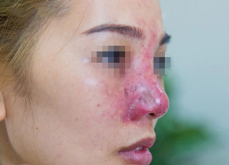Infection and nasal damage may occur after rhinoplasty.