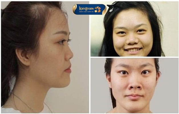 People with an upturned, wide, coarse, or unbalanced nose may consider this procedure.