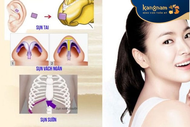 Autologous cartilage rhinoplasty uses graft material harvested from the patient’s own body.