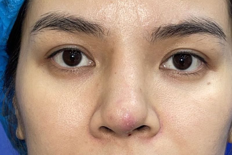 Nasal fluid accumulation may occur after surgery.