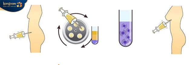 Through each stage, fat is refined to be used for breast augmentation