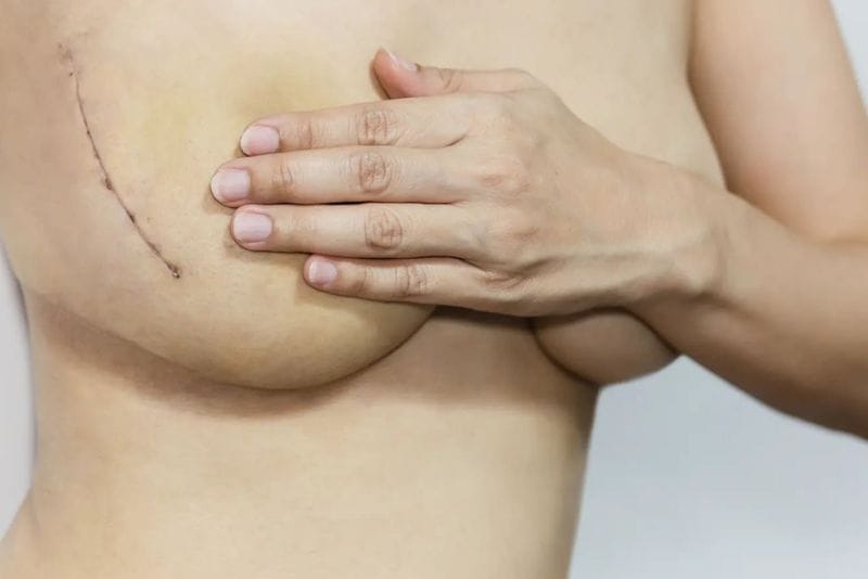 Chăm sóc sai cách sau nâng ngực khiến sẹo không mờ