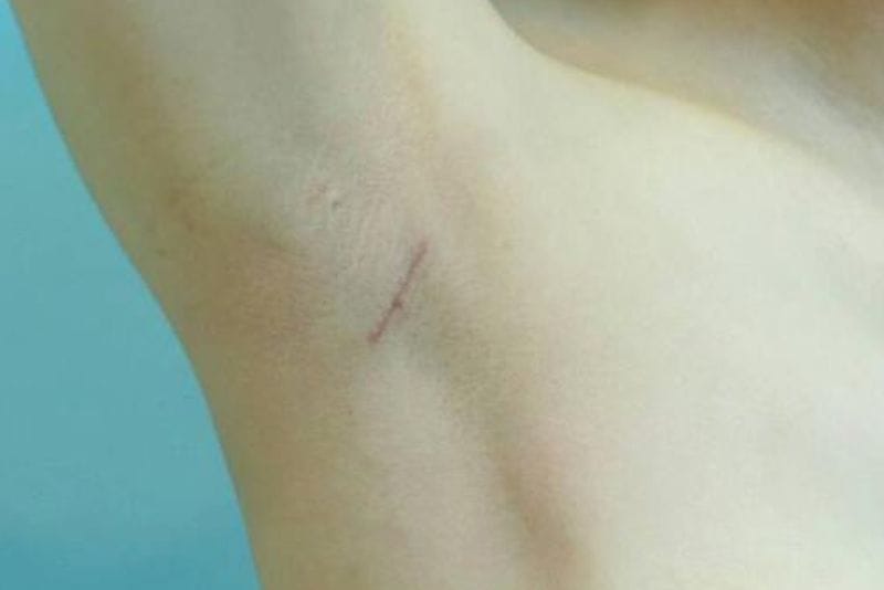 Transaxillary breast augmentation minimizes scarring to the maximum extent