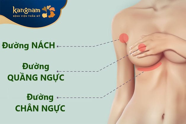 Thông thường có 3 đường mổ cơ bản được sử dụng để đặt túi ngực khi nâng ngực