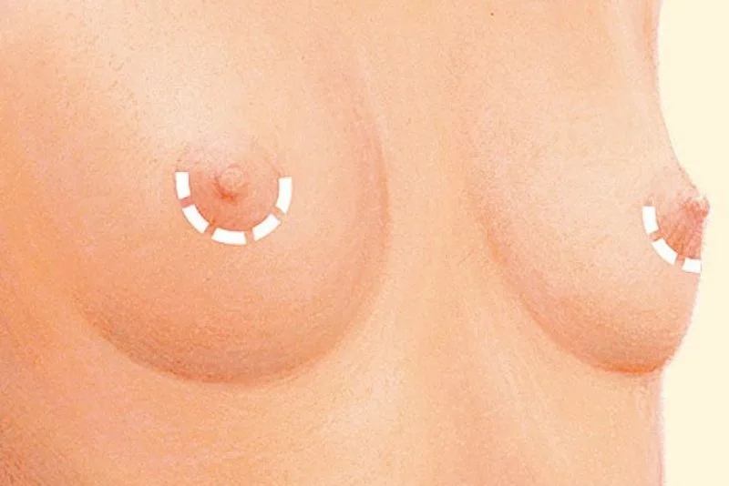 Periareolar breast augmentation is chosen by many people