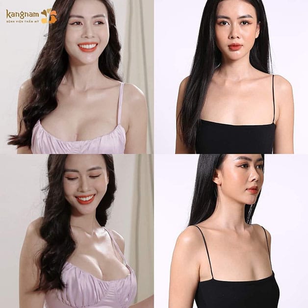 Kangnam features reasonable breast augmentation costs, corresponding to premium service quality