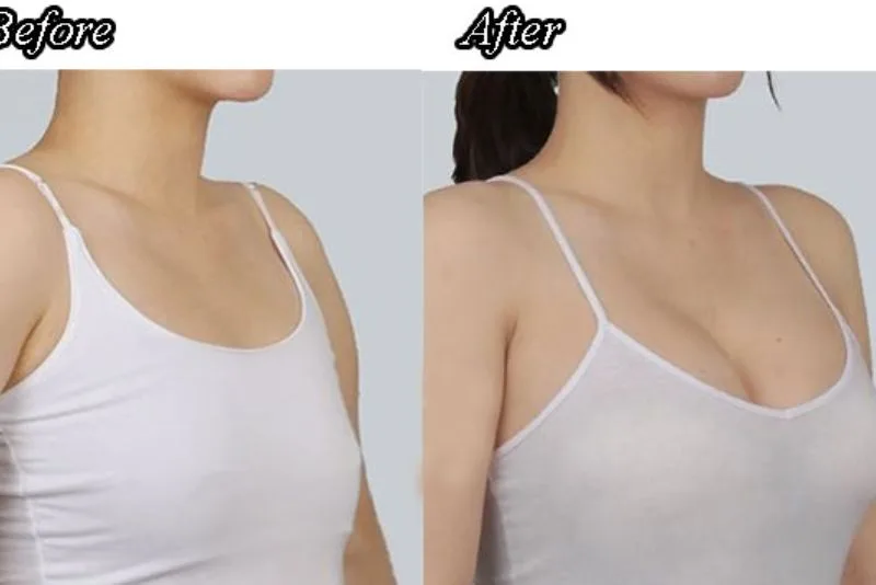 Non-surgical breast augmentation is quick and minimally invasive
