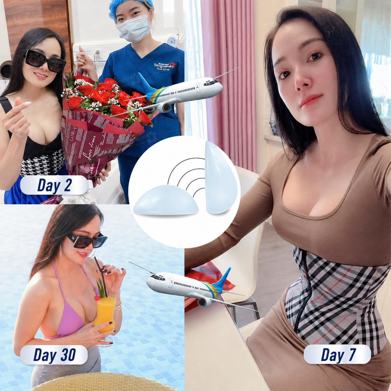 Images of overseas Vietnamese clients undergoing breast augmentation at Kangnam: