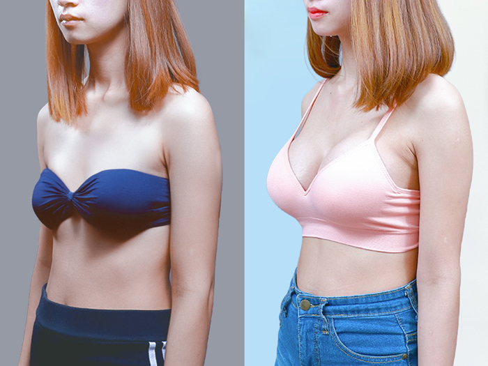 Mastopexy helps create a balanced, firm, and captivating bustline