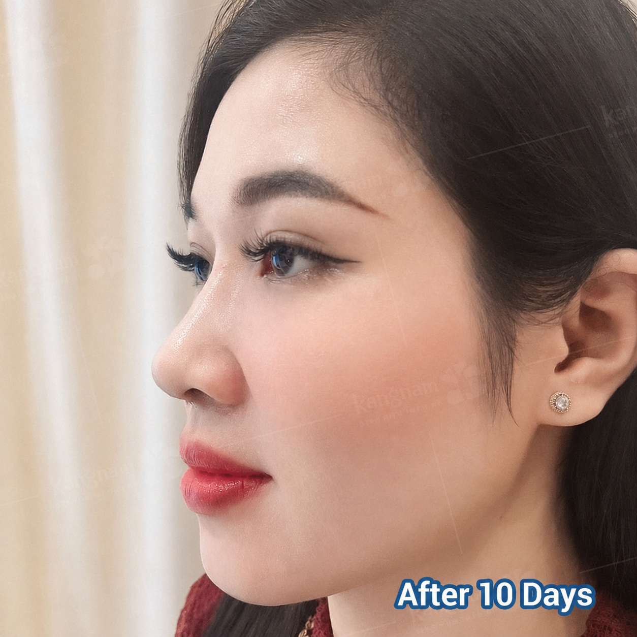 Overseas clients enjoy exclusive privileges during nasal revision at Kangnam, resulting in fast healing and stability
