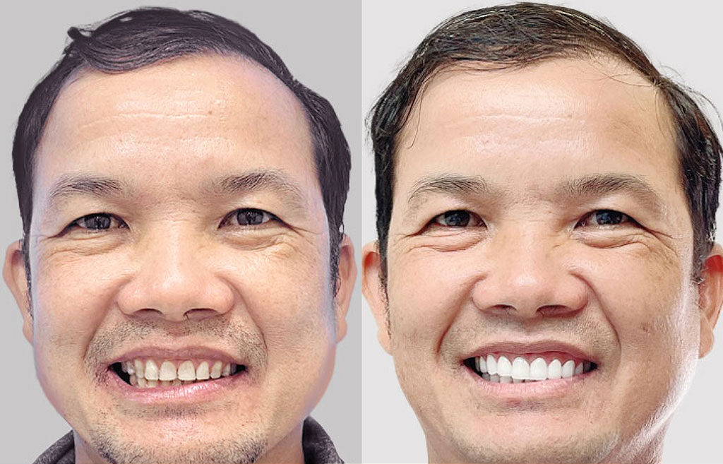 The patient shared that porcelain crown services in Vietnam are comparable to those available abroad.