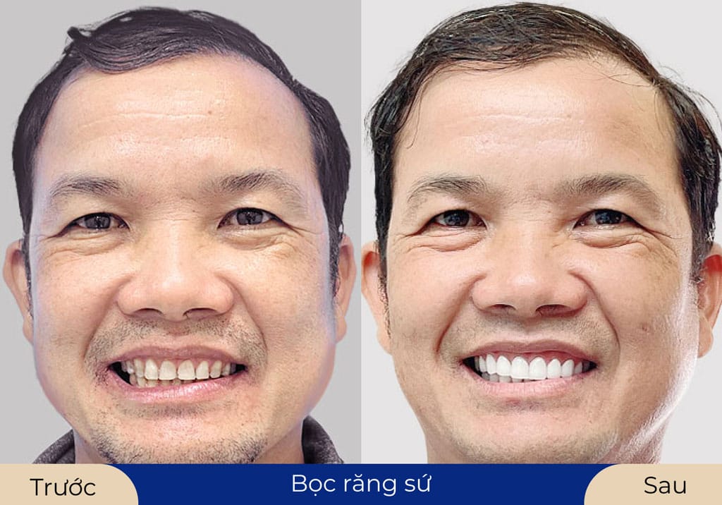 Khách hàng trước và sau khi bọc răng sứ tại Kangnam