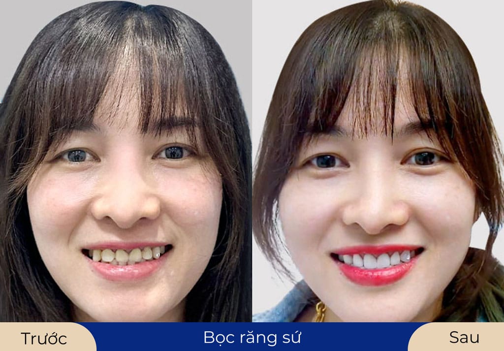 Bọc răng sứ duy trì lâu dài