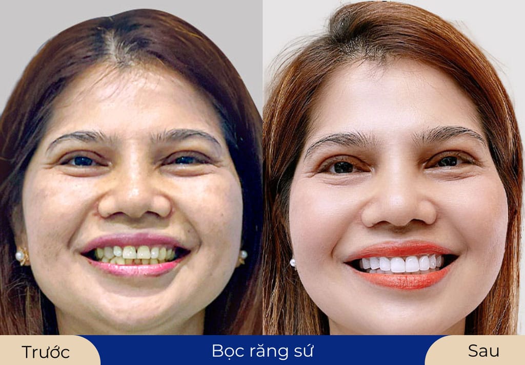 Bọc răng sứ cải thiện răng ố vàng, không đều