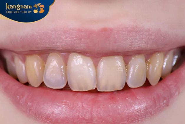 Răng bị hỏng, xỉn màu