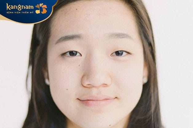 Người có cánh mũi không cân xứng, bị lệch