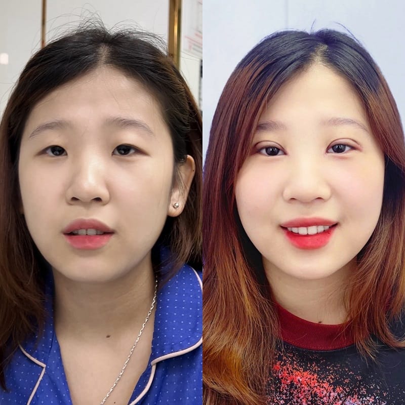 Kangnam provides modern eyelid techniques and structured postoperative guidance.