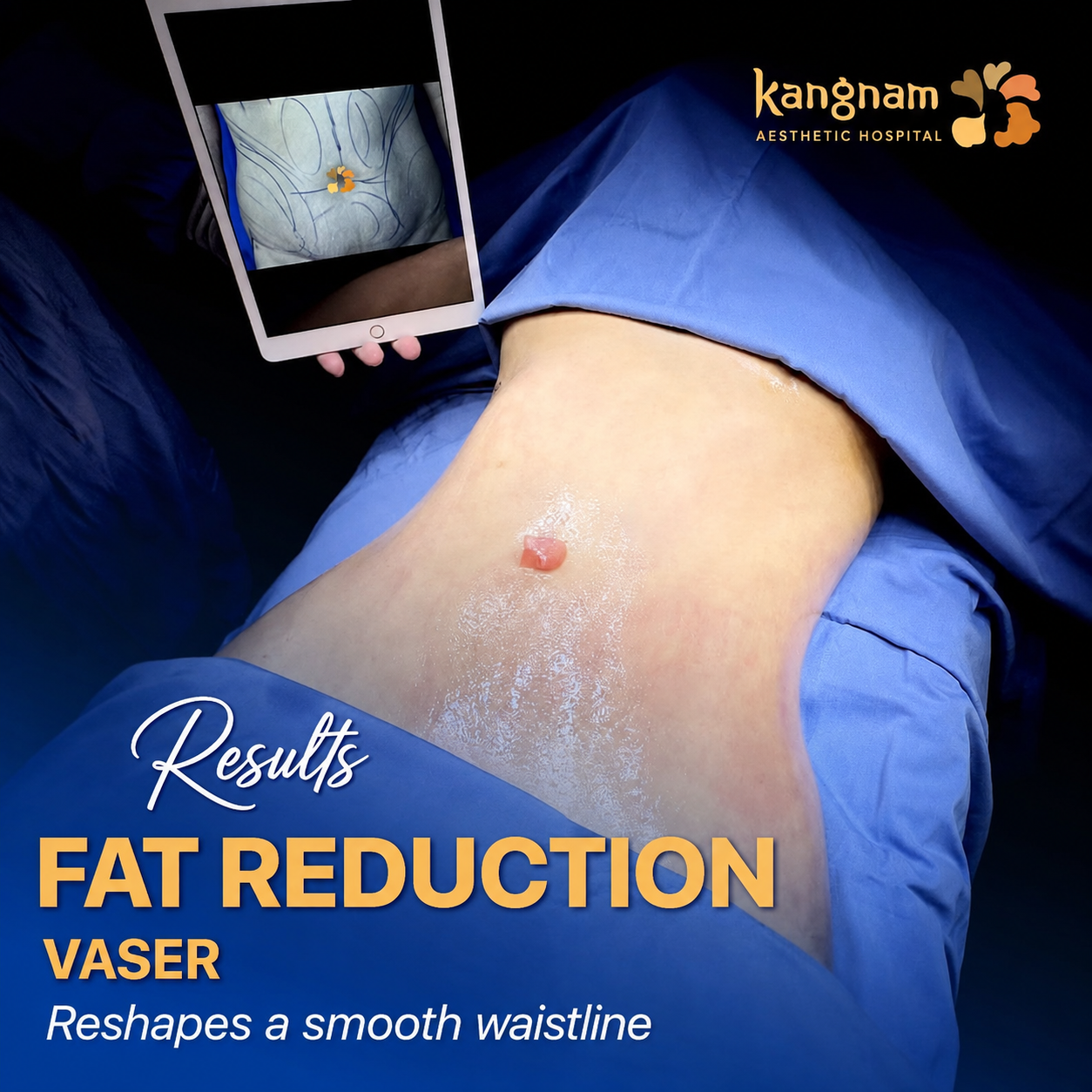 Suitable patients may achieve a slimmer-looking waist after non-surgical or minimally invasive fat reduction.