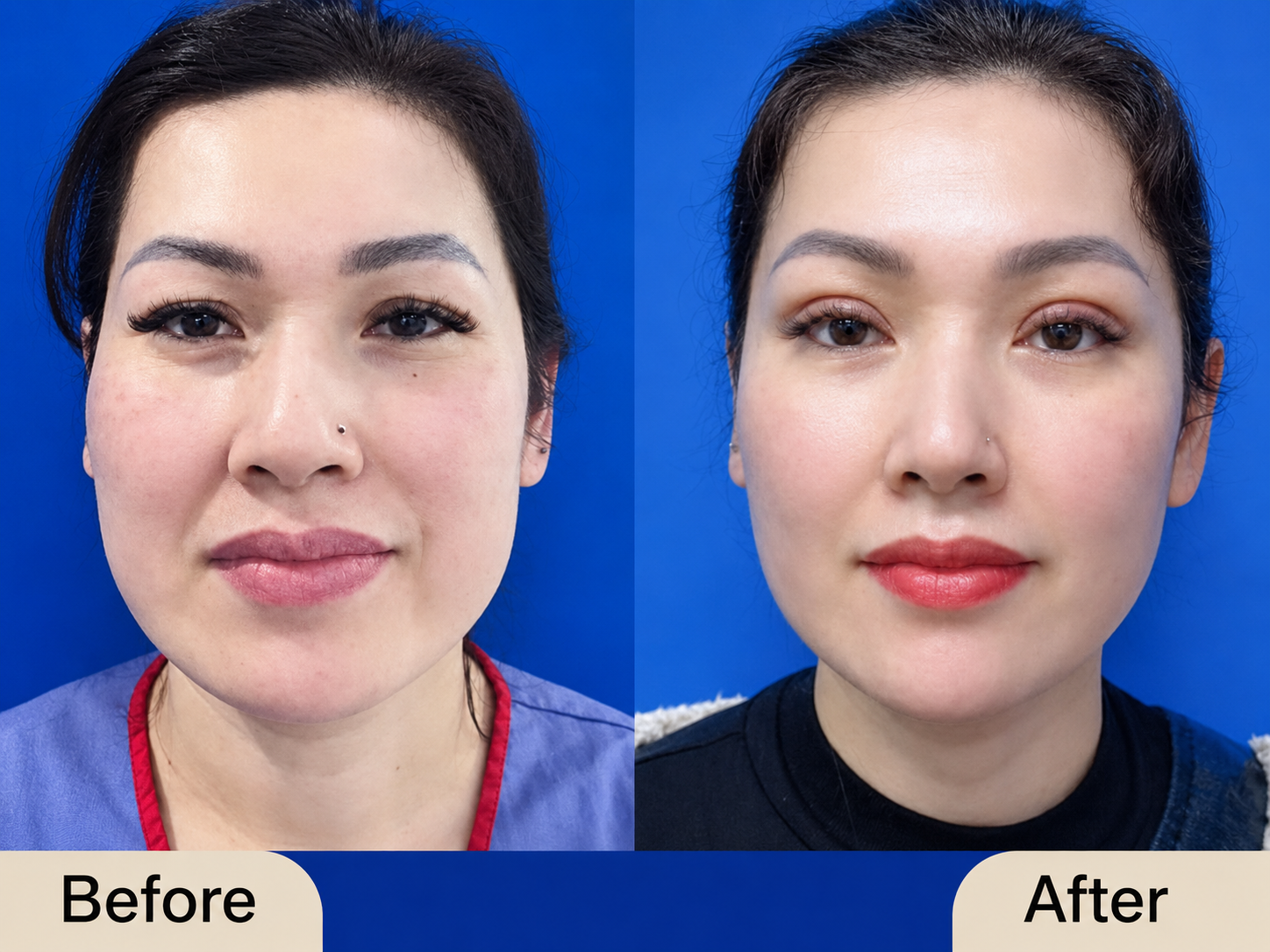 Eye-area fat grafting combined with eyelid surgery may improve hollowing and eyelid contours in suitable patients.