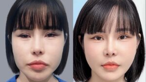Oval Face Surgery: Creating a Slim, V-Line Shape