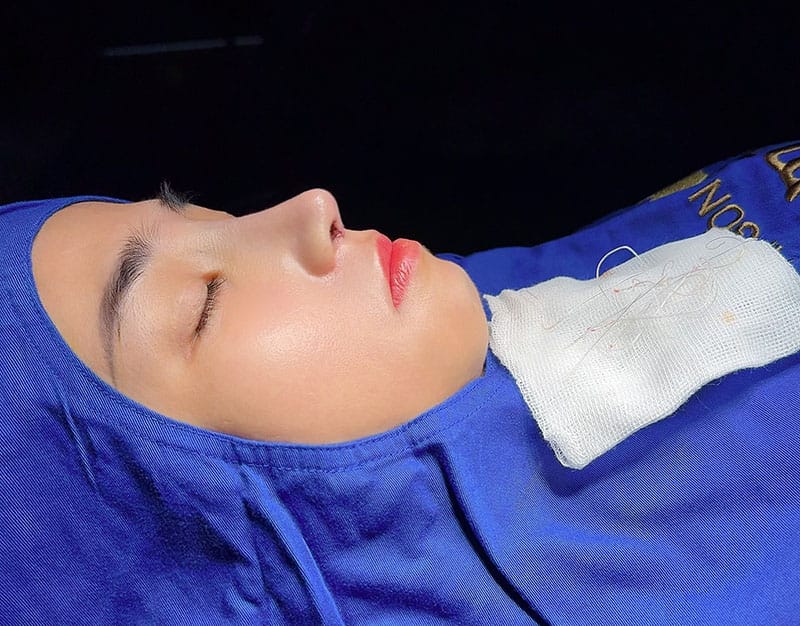 Khách hàng tỉnh nhanh sau ca nâng mũi
