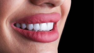 Porcelain Crowns (Dental Veneers): A Brighter, Even Smile