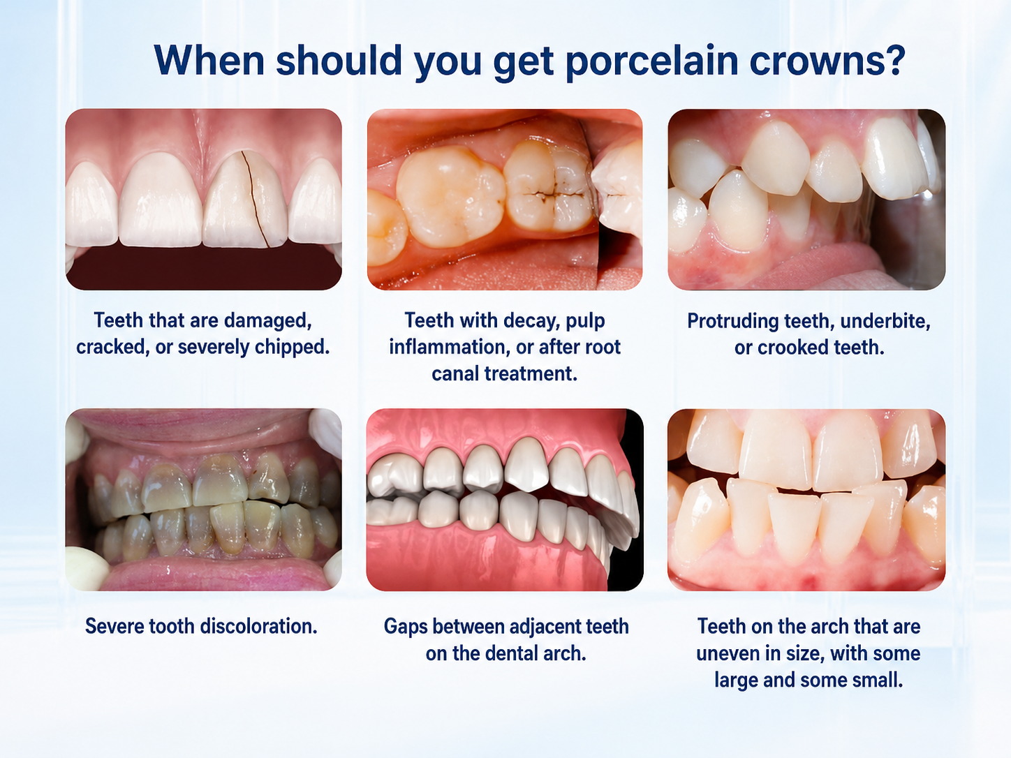 Cases suitable for porcelain crowns include damaged, decayed, protruding, or underbite teeth.